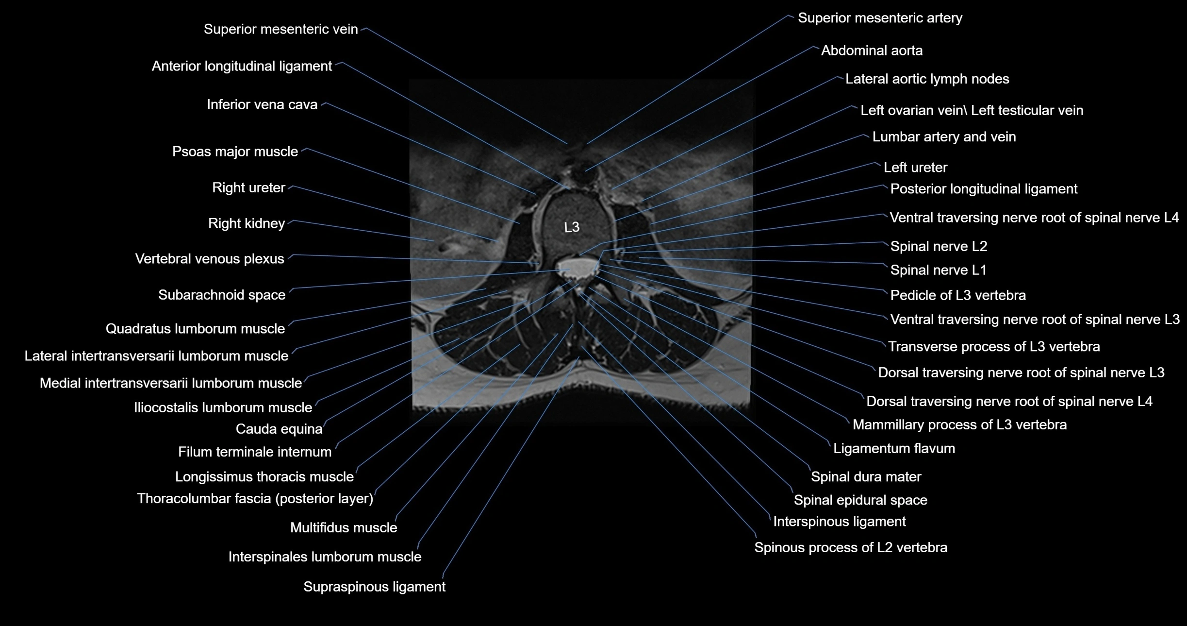 MRI lumbar spine axial cross sectional anatomy 3T radiology  image-img-00001-00021.webp